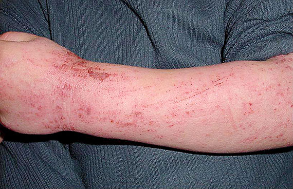 This child suffers from a bad case of atopic dermatitis, revealed by the itchy, painful crusts on his arm.