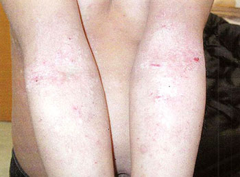 Itchy, sore and red: this is what a skin rash commonly seen in the Baffin region looks like. The rash, which is linked to allergies, can be treated if it's not severe, said Dr. Robert Jackson, a dermatologist who has visited Nunavut for more than 10 years.