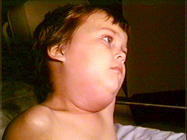This photo shows the kind of swelling that can occur with the infectious virus, mumps. (PHOTO/WIKIPEDIA)