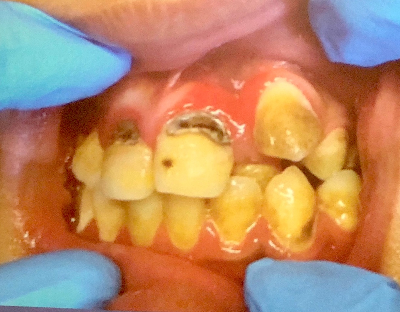 When dentists see crooked and rotten teeth like these in Nunavut, there is not much they can do except try to repair them or pull them. Orthodontists often refuse to put on braces to correct the teeth due to their poor condition. (PHOTO COURTESY OF MARTA DEMUTH)